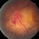 Non-Small-Cell Lung Cancer  Choroidal Meta OS Fundus Non-Small-Cell Lung Cancer  Choroidal Meta OS Fundus